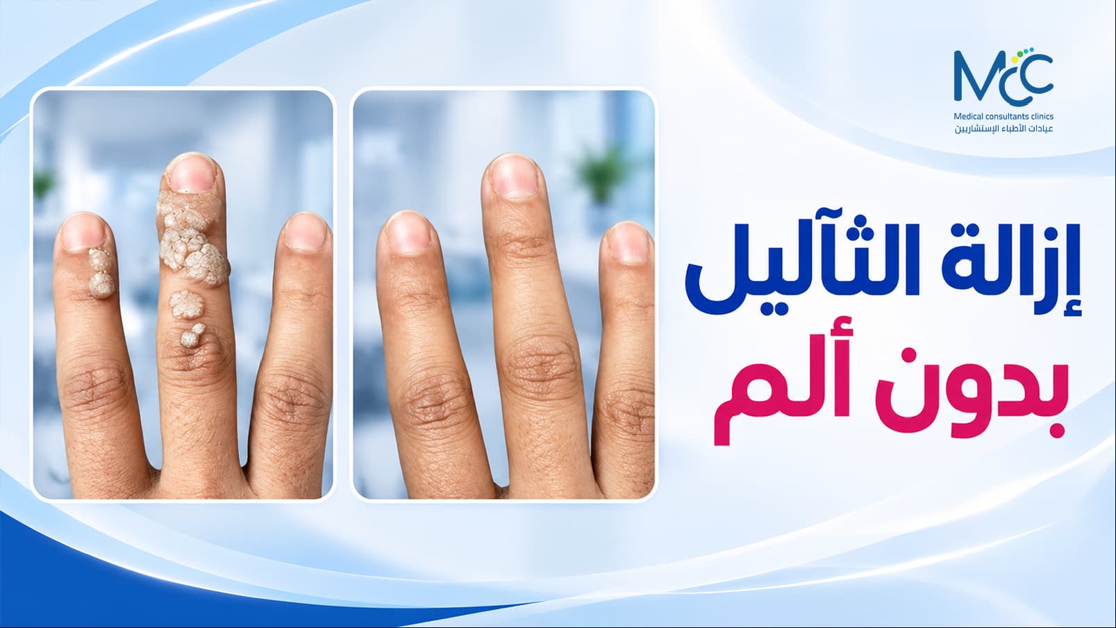 علاج الثالول